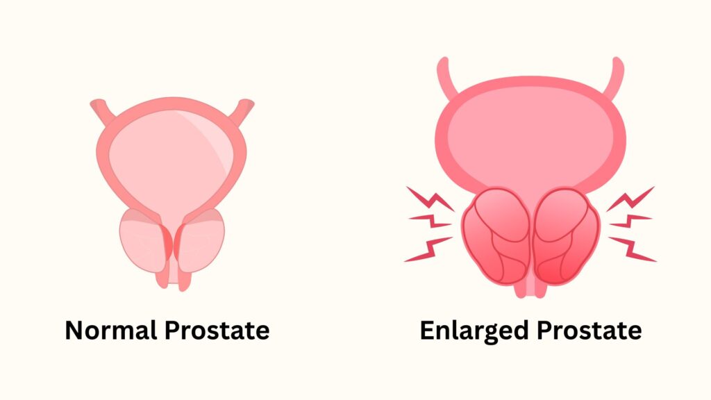 benign prostatic hyperplasia (bph)