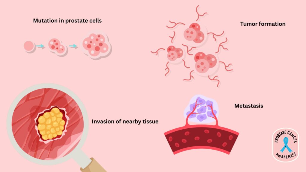 how does cancer develop in the prostate