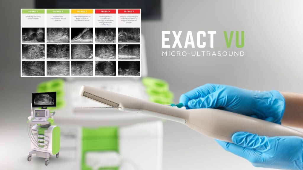 revolutionary advancement in prostate cancer diagnosis exact vu micro ultrasound